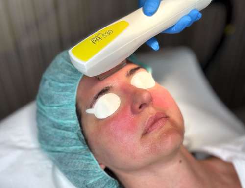 Erfahrungsbericht – Couperose – Rosacea Behandlung mit Laser im Gesicht in Wien bei JUVENIS